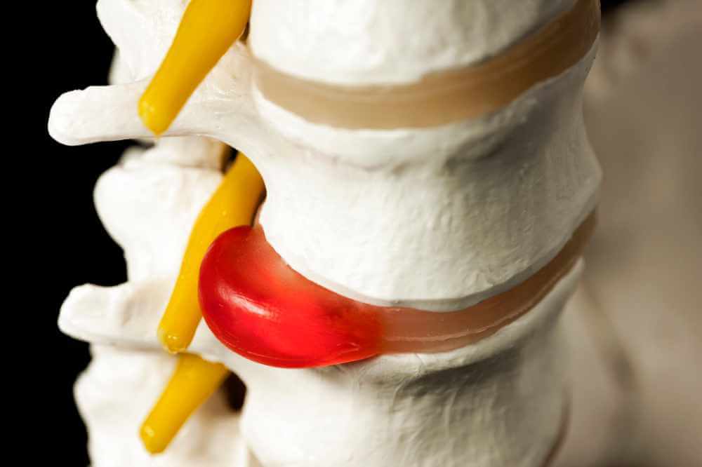 Herniated and Bulging Discs